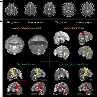 A Review of Traumatic Axonal Injury following Whiplash Injury As Demonstrated by Diffusion Tensor Tractography